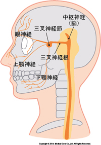 三叉神経痛施術イメージ